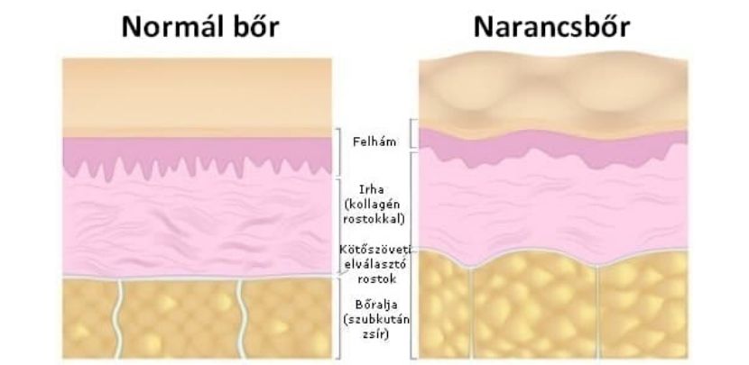 Narancsbőr vagy megereszkedett bőr? Győr legújabb cellulit- és bőrfeszesítő kezeléseivel simább, feszesebb bőrt érhetsz el fájdalommentesen! Tüntesd el a cellulitot gyorsan és hatékonyan! 📍 Lotus Body, Győr, Babits Mihály utca 38/C. ☎️ +36 70 944 4488
